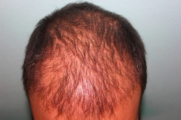 Saç Çıkaran Bitkiler Kullanımı ve Faydaları Nelerdir? Saç Çıkaran Bitkiler Kullanımı ve Faydaları Nelerdir?