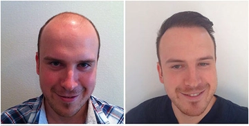 Saç Nakli Belirtileri ve Tedavisi Saç Nakli Belirtileri ve Tedavisi